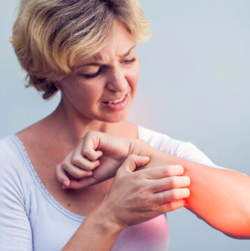 A woman with short blond hair scratches her irritated, red forearm, showing discomfort—an experience often associated with itchy skin during perimenopause or menopause.